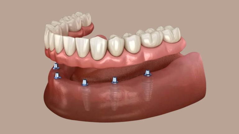 Cost and Value of Full Mouth Dental Implants