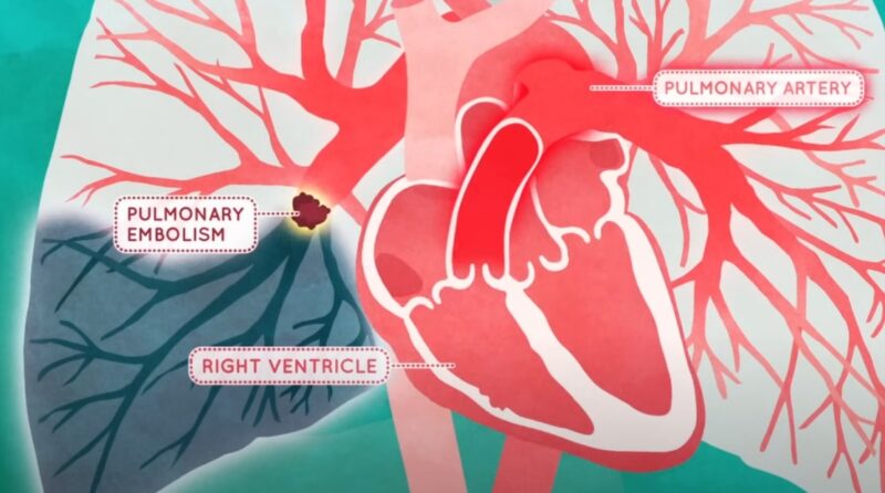 An illustration of pulmonary embolism