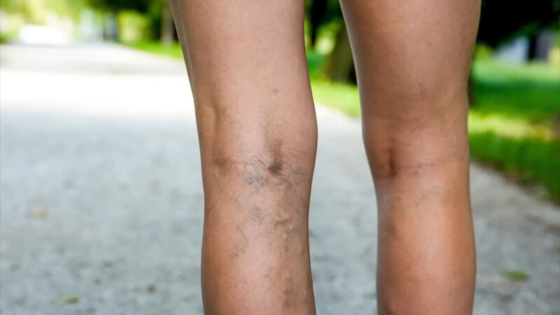 A woman with varicose veins on her legs