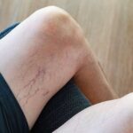 how to identify and prevent burst veins