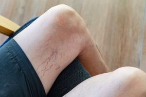 how to identify and prevent burst veins