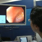 Colonoscopy risks and benefits