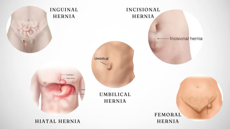 Definition and Types of Hernias