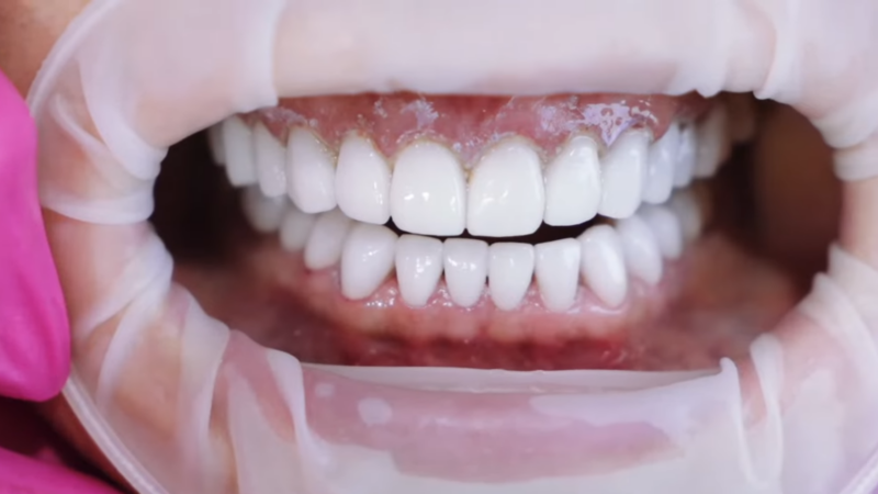 Close-Up of A Dental Procedure for A Hollywood Smile