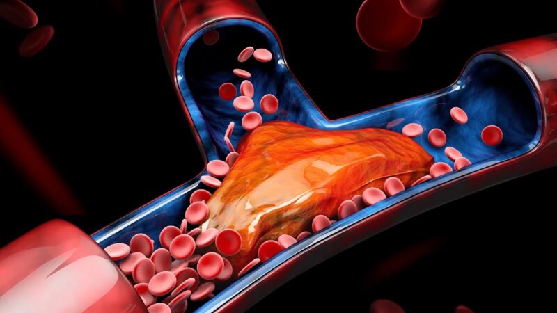 A 3D-rendered medical illustration of a blood clot blocking an artery.