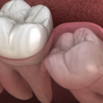 Close-Up of Wisdom Teeth with Visible Gum Tissue Around Them