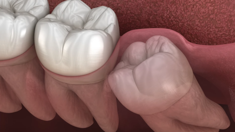 Close-Up of Wisdom Teeth with Visible Gum Tissue Around Them